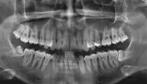 OPG Dental